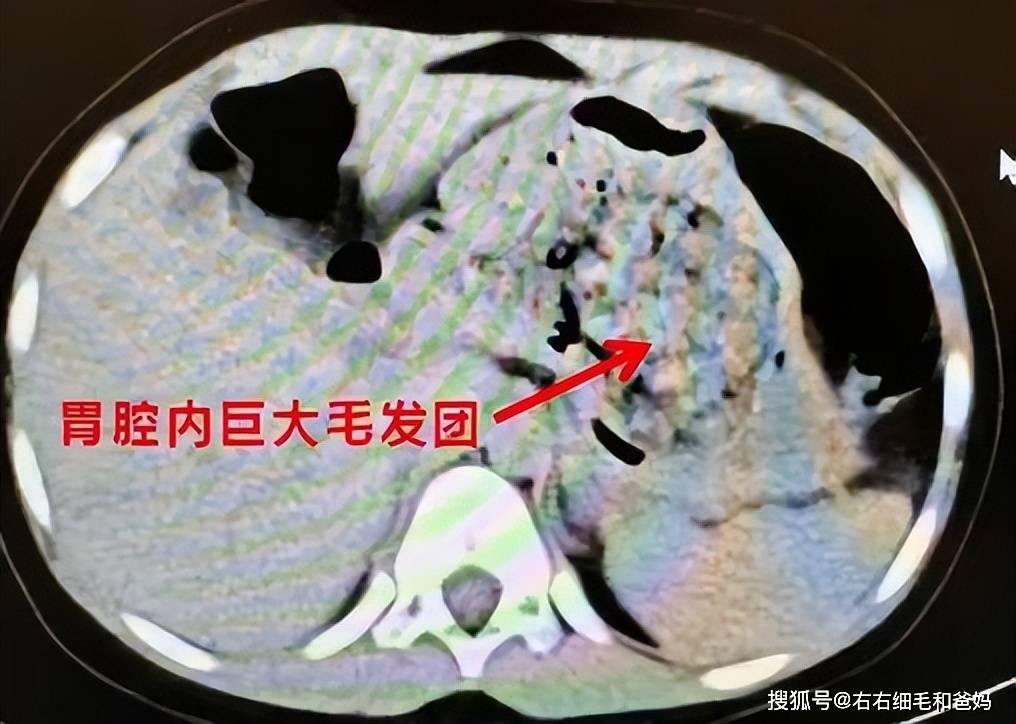 谨防儿童的“长发公主病”：名字好听病难治严重的还得手术治疗(图3)